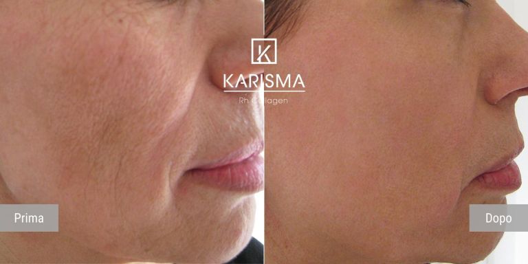 KARISMA - Softfiller biorestitutivo | Rh Collagen