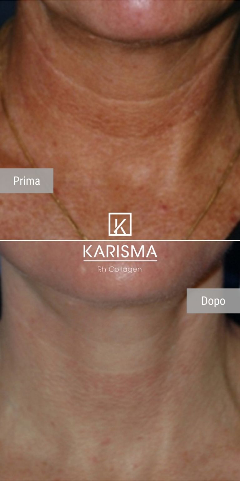 KARISMA - Softfiller biorestitutivo | Rh Collagen